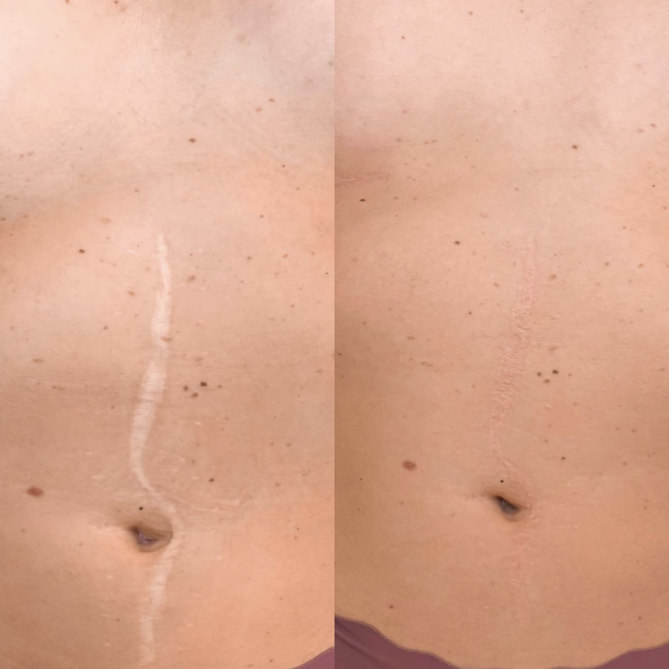 Narben Camouflage München - Vorher Nachher Vergleich