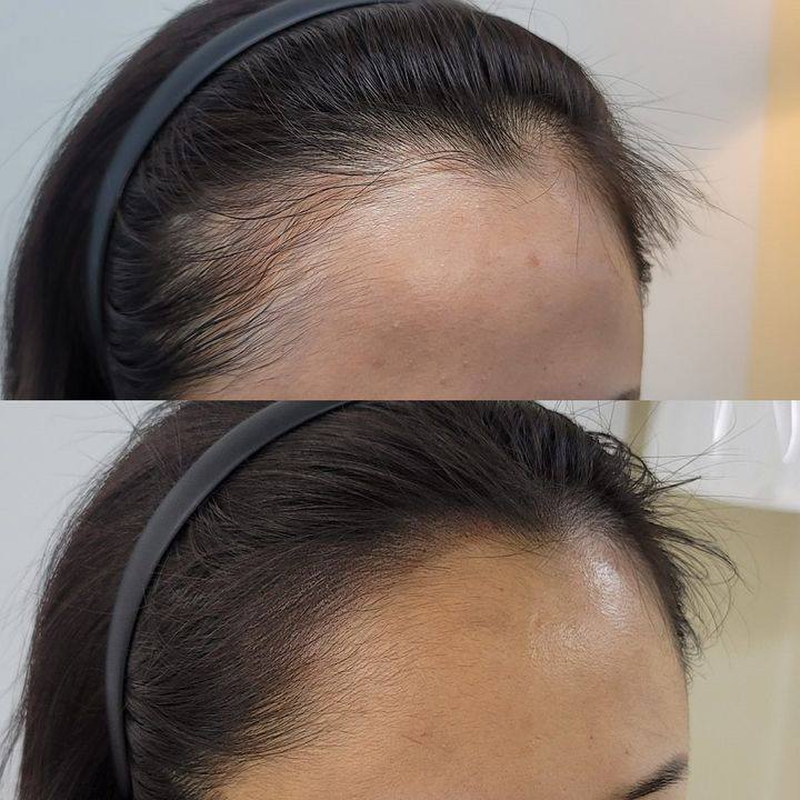 Trichopigmentierung München - Professionelle Kopfhaut Pigmentierung bei Haarausfall