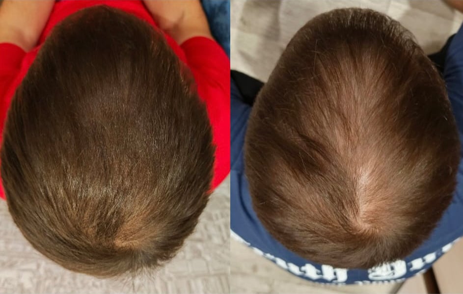 Scalp Micropigmentation München - Natürliches Haarpigmentierung Ergebnis